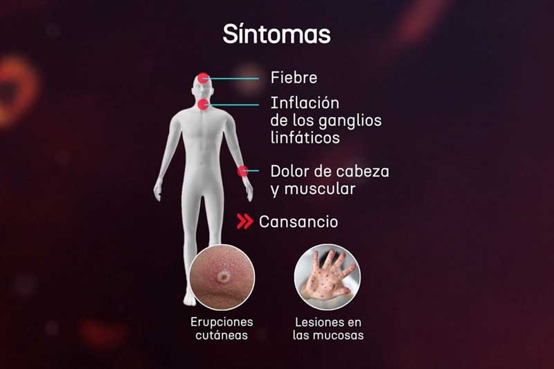 Según el último Boletín Epidemiológico Nacional, la situación a nivel país muestra un preocupante incremento. En lo que va de 2025, se notificaron 58 nuevos contagios, con un promedio de seis casos semanales desde abril y un pico de diez a inicios de mayo. El informe detalla que en al menos diez situaciones se identificaron antecedentes de viaje o contacto con viajeros, principalmente desde Brasil y Chile. Además, en 12 casos, el principal factor de exposición fue el antecedente de relaciones sexuales entre hombres, un dato clave para las campañas de prevención y seguimiento epidemiológico.