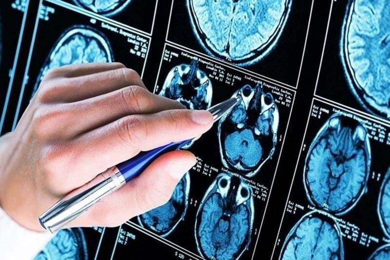 La inteligencia artificial es capaz de identificar patrones no perceptibles para el ojo humano, lo que resulta crucial en este proceso. Diego Fernández Slezak, investigador de la UBA, destacó que están explorando diversas aplicaciones de algoritmos avanzados en el ámbito de la salud mental y neurológica. 