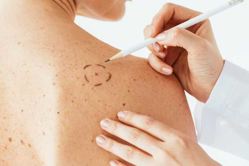 La terapia, que demandó más de tres décadas de investigación, apunta a reforzar la respuesta inmunológica para atacar células tumorales residuales y disminuir la probabilidad de metástasis. Según especialistas, presenta pocos efectos adversos y puede combinarse con otras líneas de tratamiento si fuera necesario. Su presentación formal ocurrió en la última edición del Curso Intensivo de Perfeccionamiento Dermatológico de la Sociedad Argentina de Dermatología, en medio de la expectativa por sumar una herramienta adicional para pacientes con riesgo de recaída.